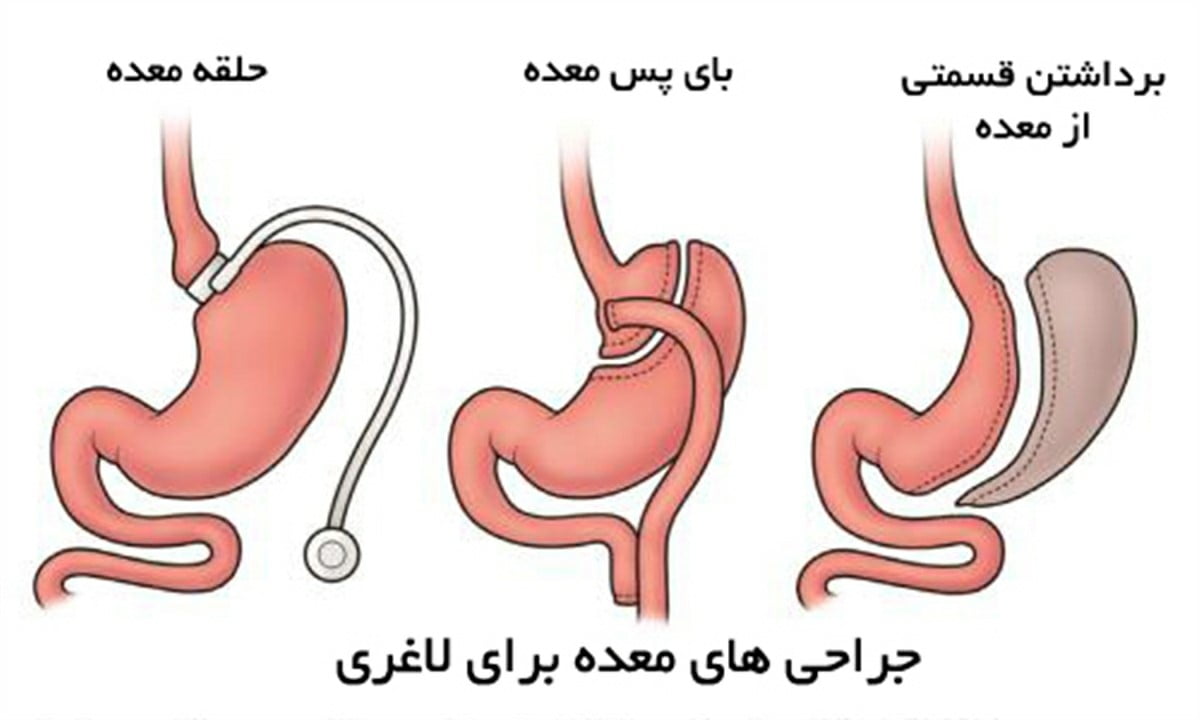 انواع جراحی لاغری
