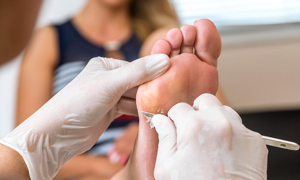 جراحی میخچه پا به چه صورت انجام می شود؟